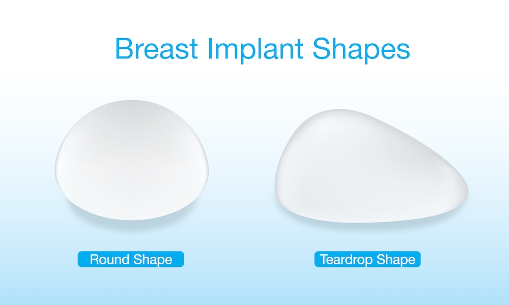 Breast implants infographic