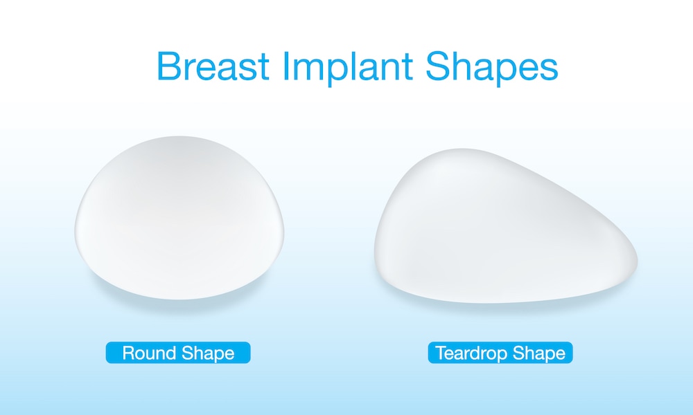 Breast Augmentation with Implants in Kelowna, BC